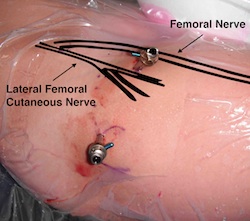 Hip Scope Nerves at Risk